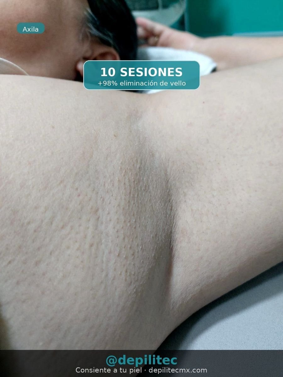Resultado depilación láser axila - 10 sesiones +98% eliminación