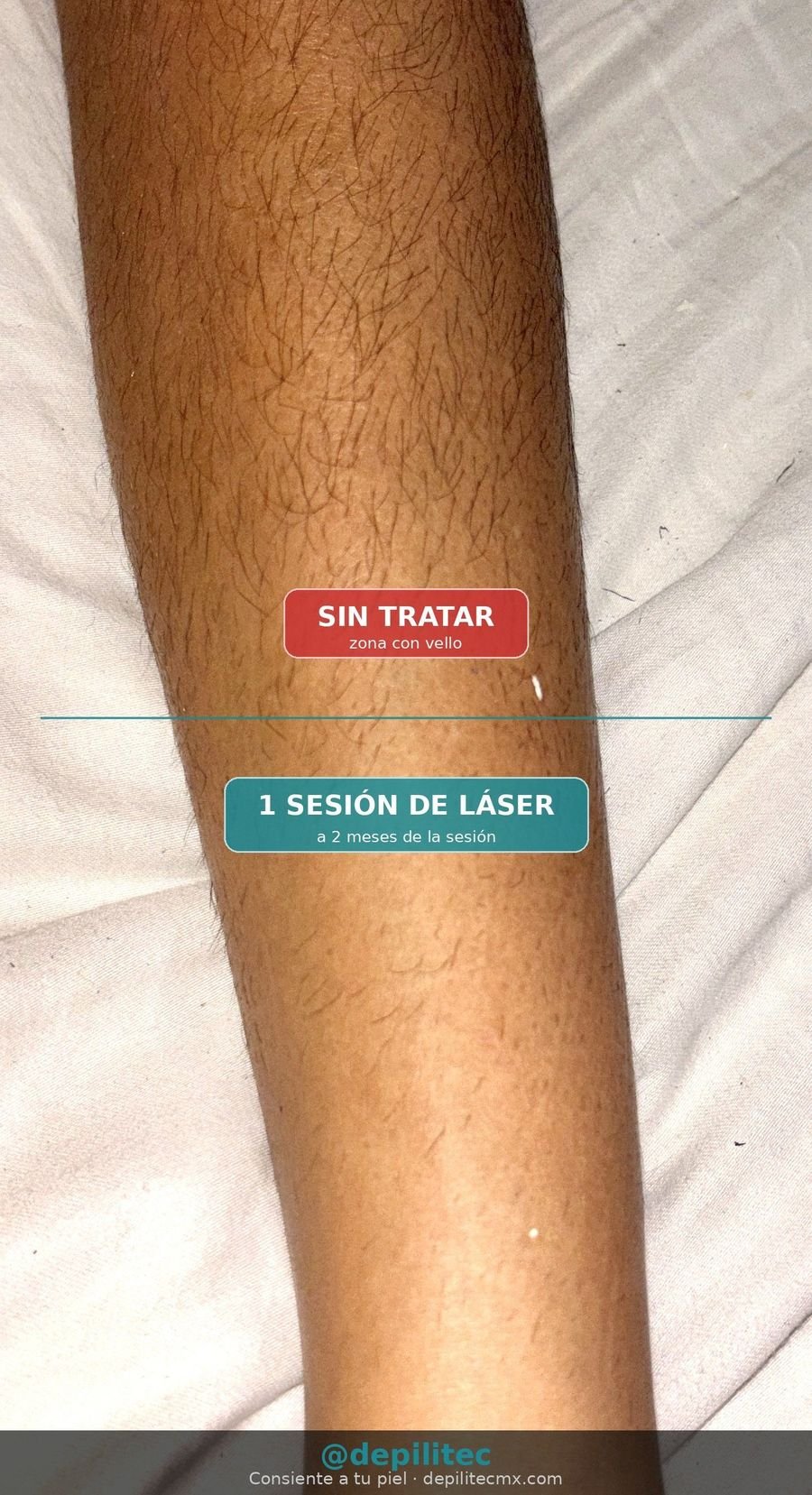 Resultado depilación láser piernas - 1 sesión a 2 meses
